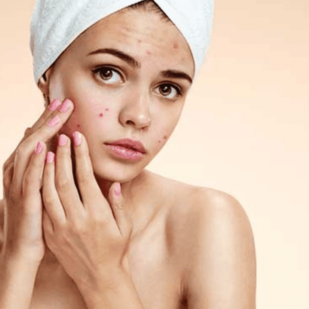 Treatment for Acne Skin