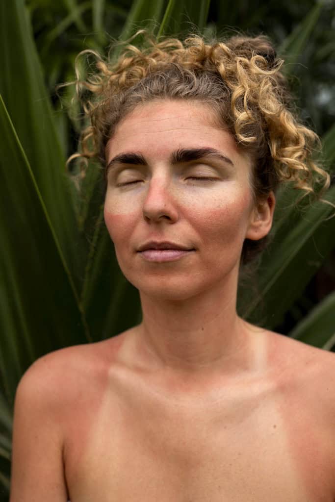 sun damage